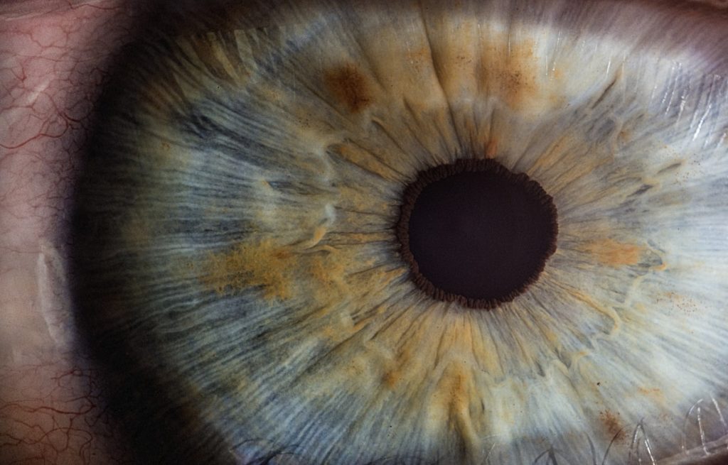 Primer plano de un ojo mostrando los síntomas del ojo seco